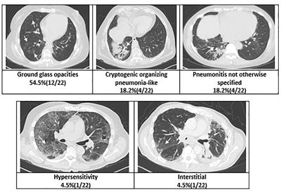 Risk of Developing Checkpoint Immune Pneumonitis and Its Effect on Overall Survival in Non-small Cell Lung Cancer Patients Previously Treated With Radiotherapy